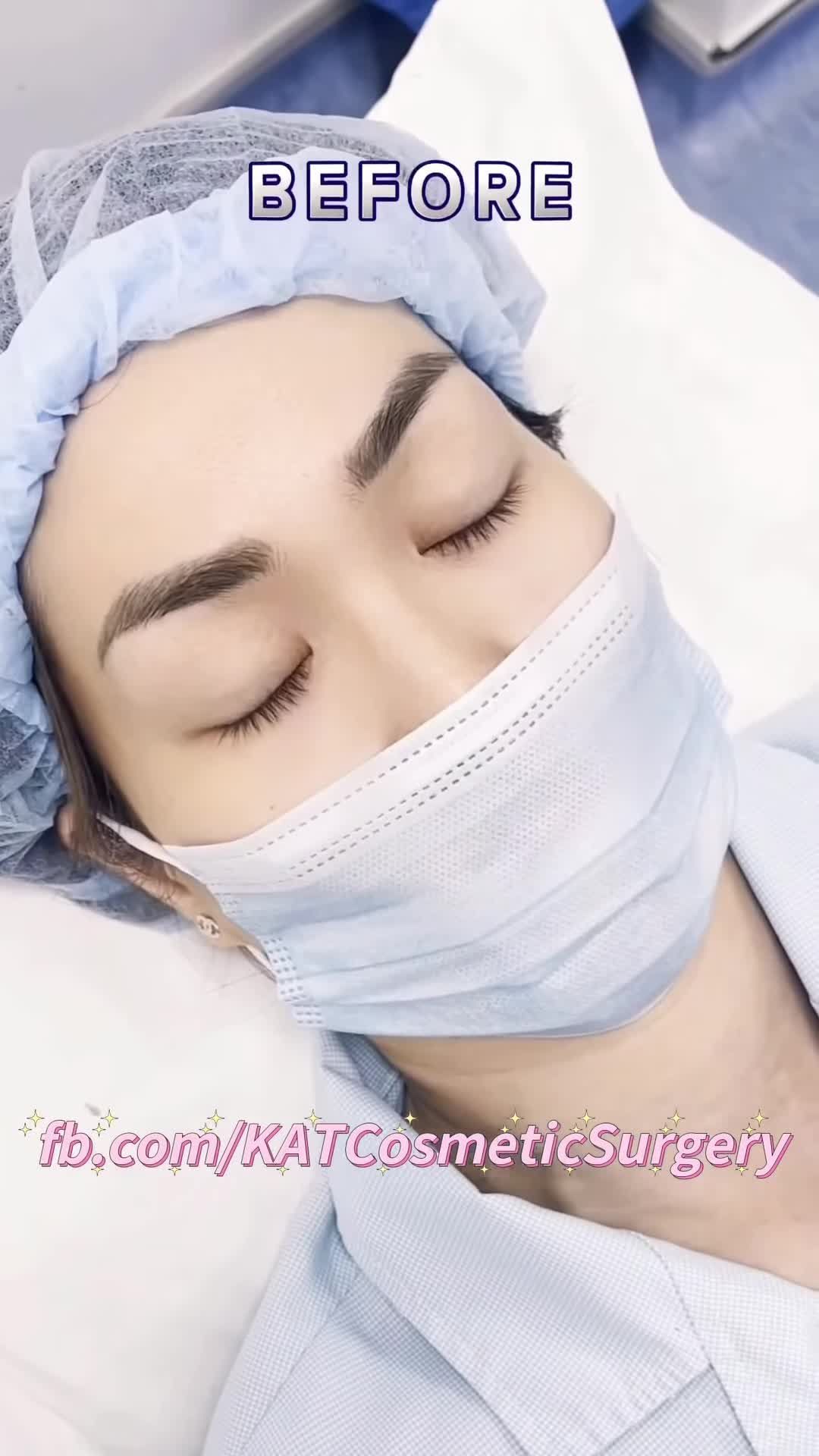 Biến hình từ đôi mắt mí lót thành đôi mắt 2 mí xinh lung linh chỉ sau 15’